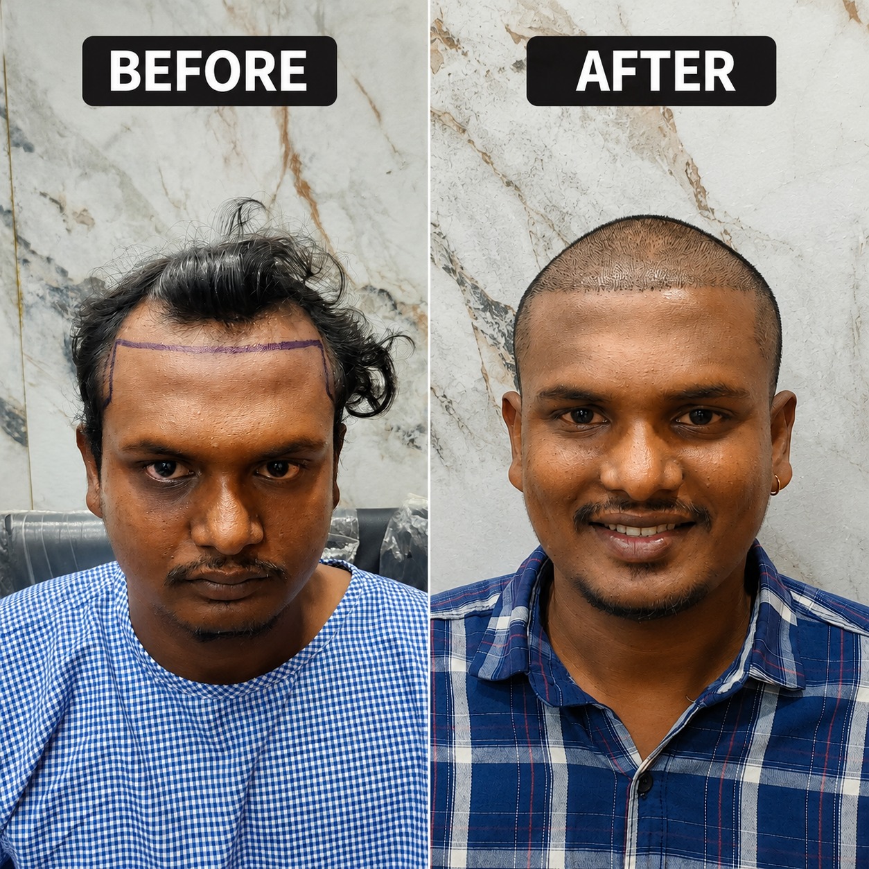 10 Days After Hair Transplant Recovery