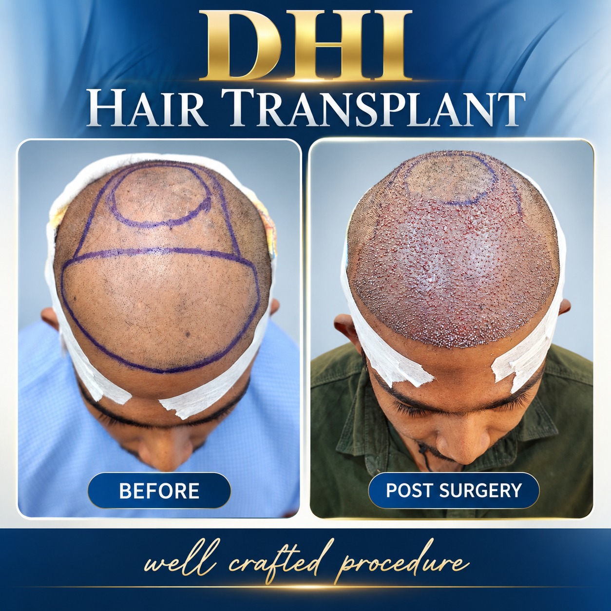 DHI Hair Transplant in Chennai: A Precision Approach to Natural-Looking Hair Restoration