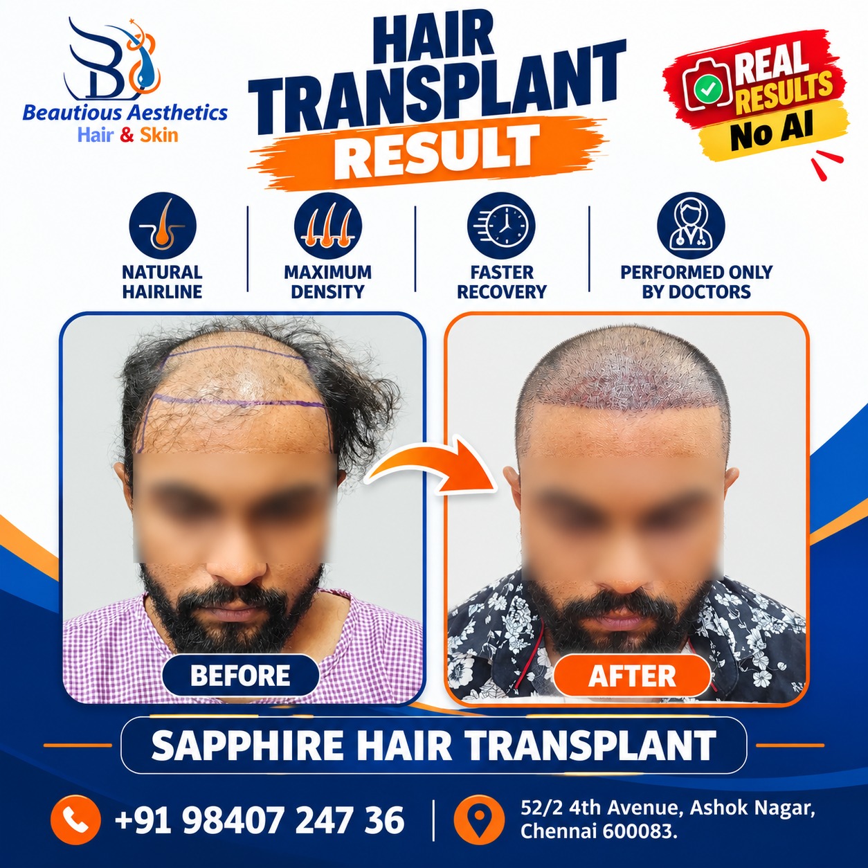 Hair Transplant Results: 4,623 Follicles with the Sapphire Method at Beautious Aesthetics, Chennai