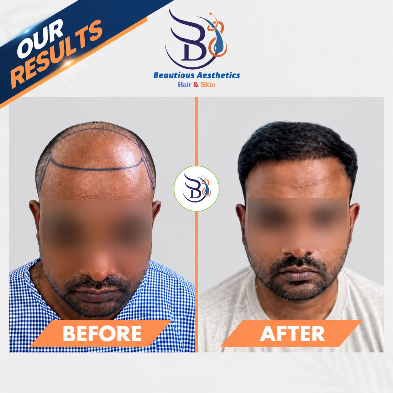 Sapphire Hair Transplant Results: A Closer Look at Sapphire FUE Hair Restoration