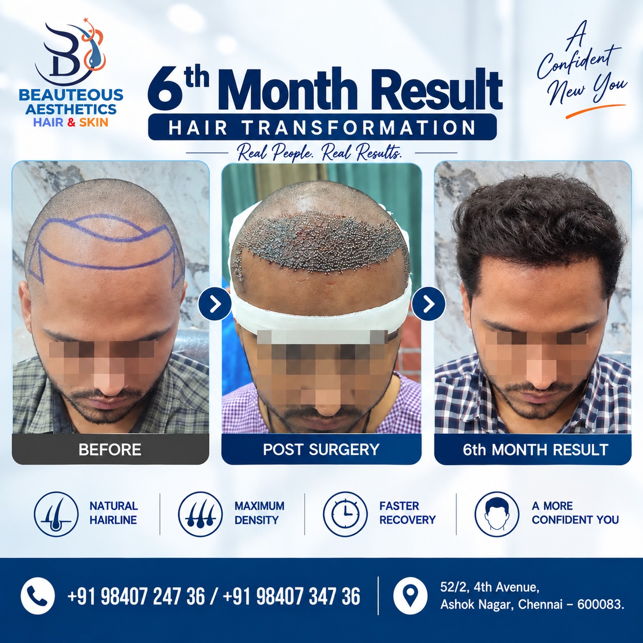 6th Month Hair Transplant Result: A Real Hair Transformation Journey in Chennai